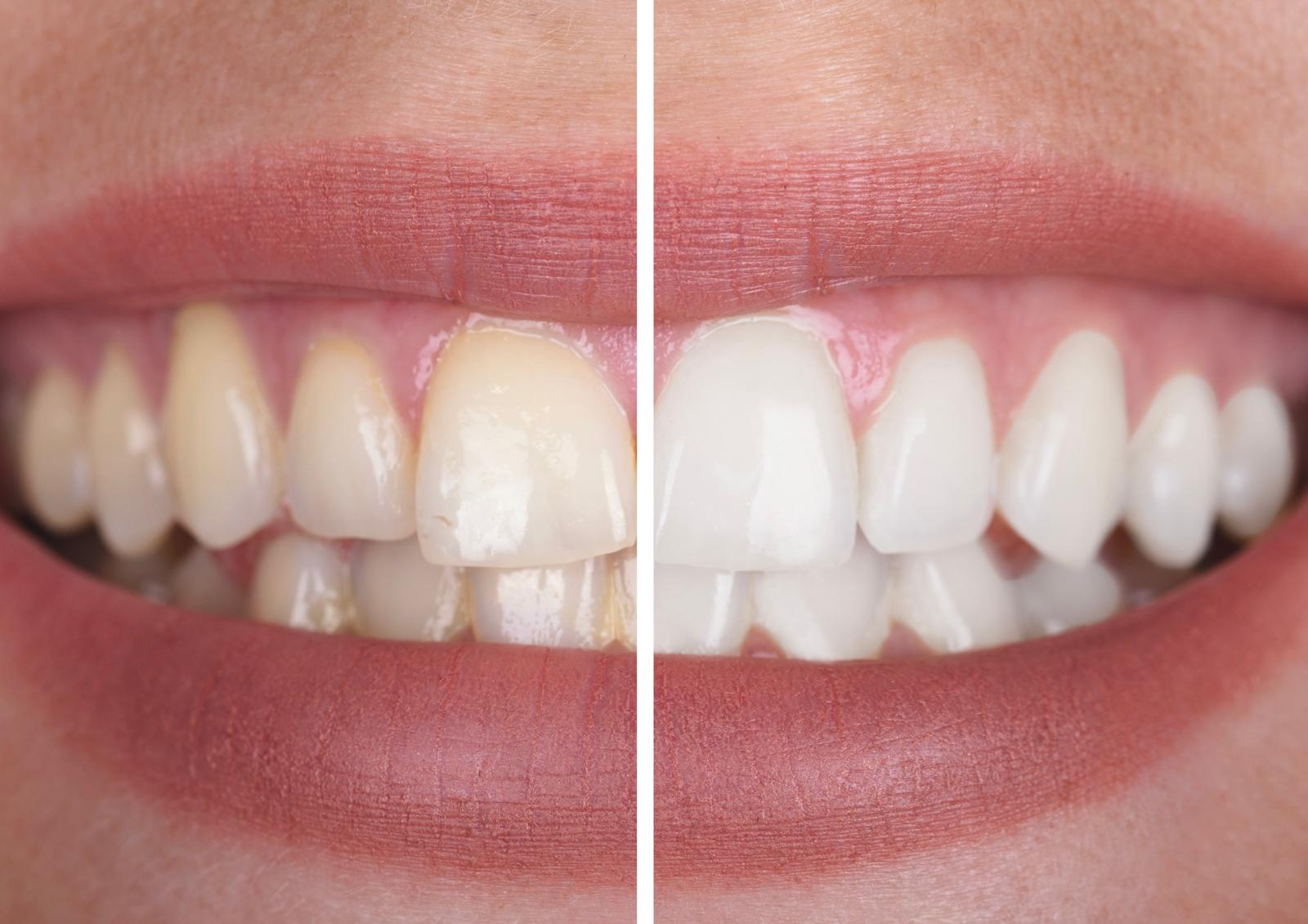 Bleaching bei YourSmile Benelux